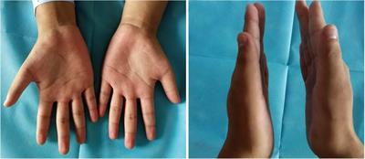 Coexistence of anomalous muscle, persistent median artery, bifid median nerve causing carpal tunnel syndrome: A case report and literature review